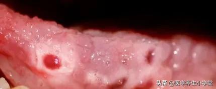 嘴巴长溃疡一般是什么原因,嘴巴经常长溃疡是什么原因引起的
