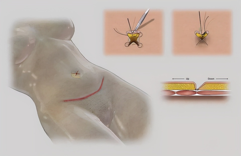 余文林整形视频全集,腹壁整形余文林