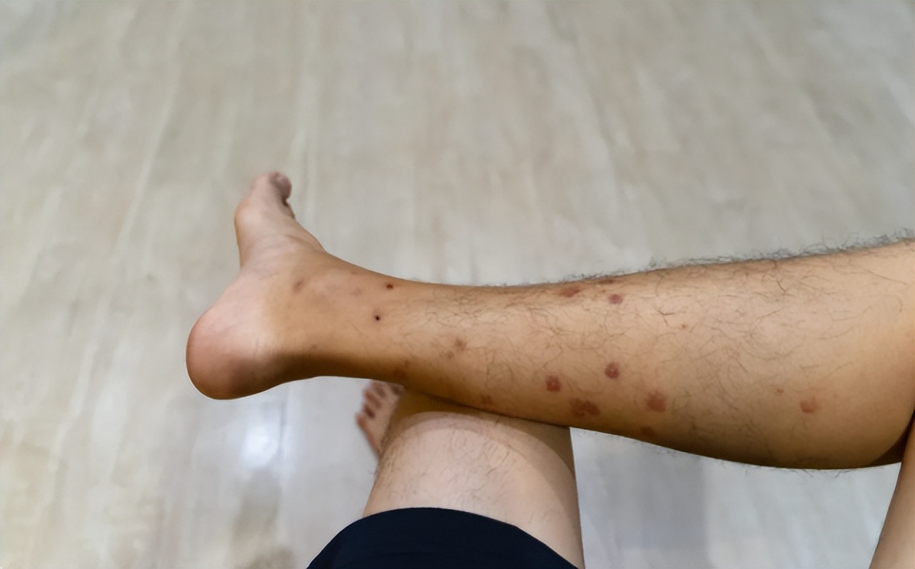 血型问题蚊子老咬我怎么办,蚊子爱咬我是因为血型么