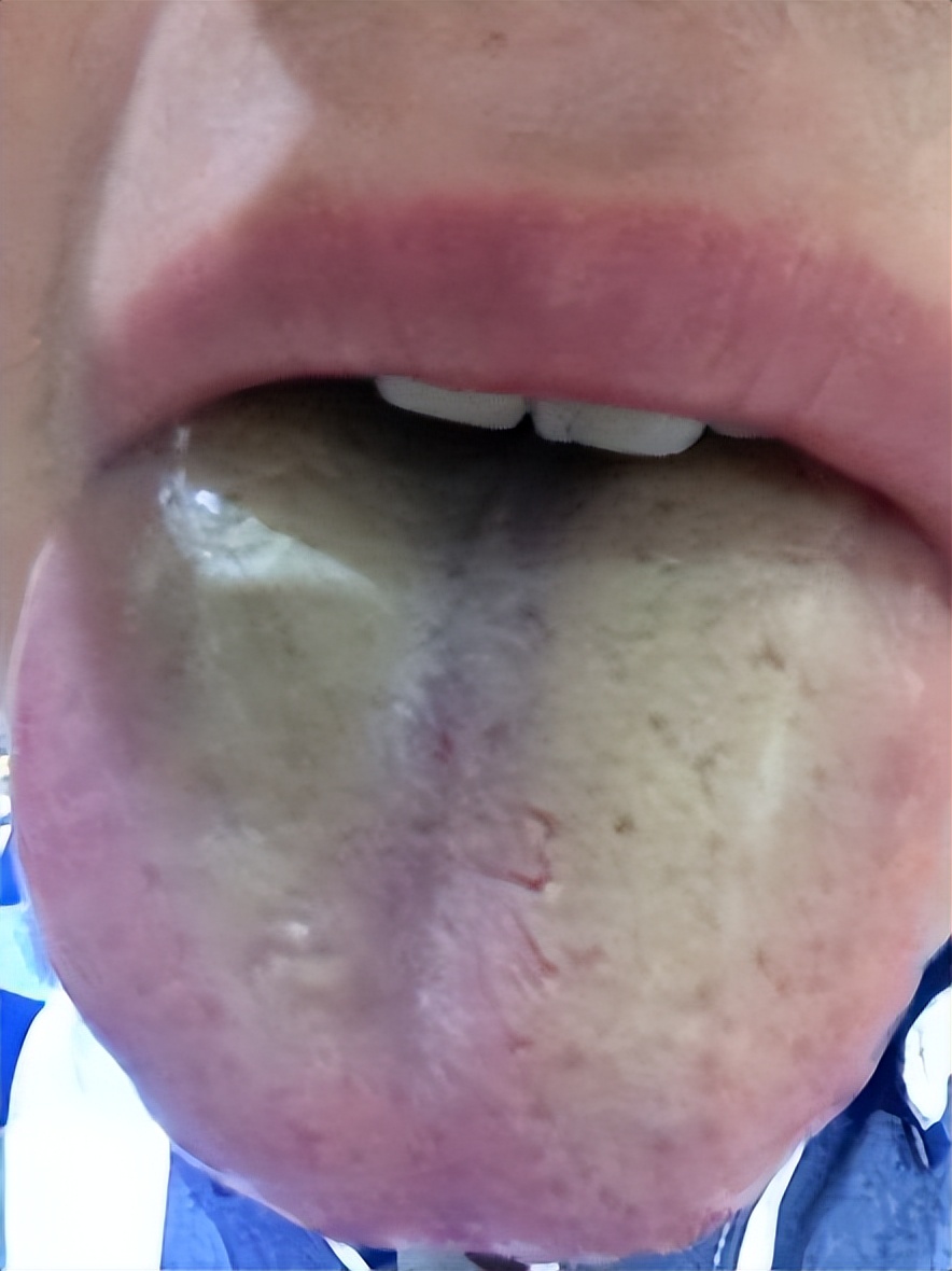 「*麻疹荨**」20%的人都会得的皮肤病，是什么原因？又该如何治疗？