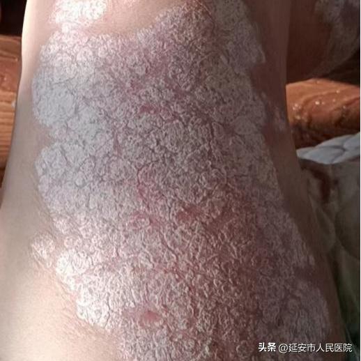 感染新冠皮肤能变好吗,新冠病毒可以通过皮肤感染吗