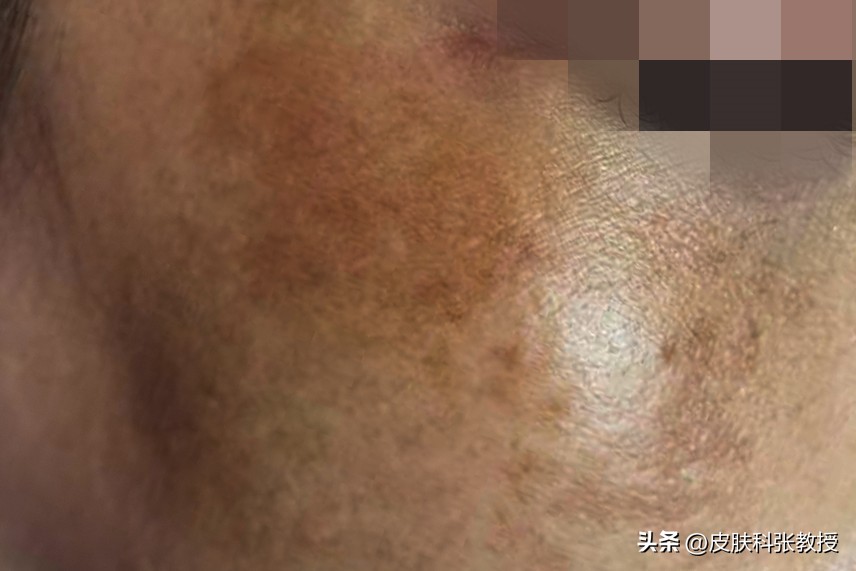常年吃药造成脸上有斑怎么治,怎么判断脸上黑点是痣还是斑