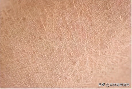 白癜风的自愈率,白癜风最新的有效治疗方法