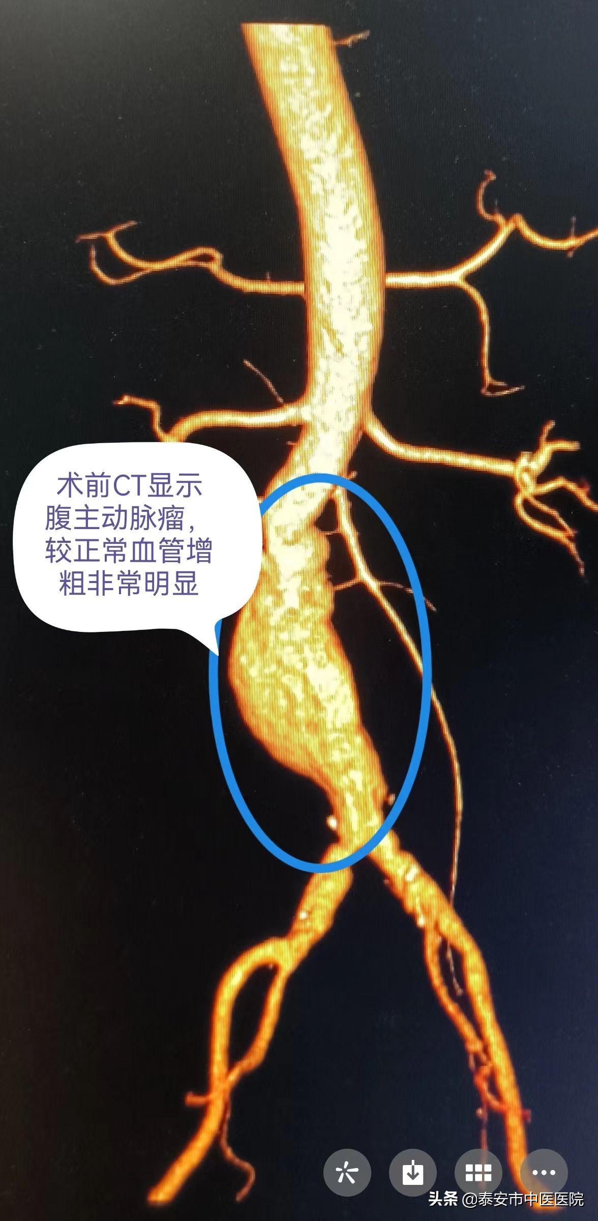 【创新技术】*安泰**市中医医院介入诊疗科：精准影像介入治疗，排除腹主动脉“不定时*弹炸**”