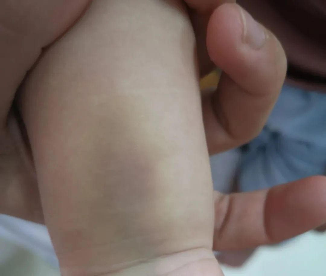 宝宝碰了个淤青好几个月不消,一个月的宝宝淤青怎么办