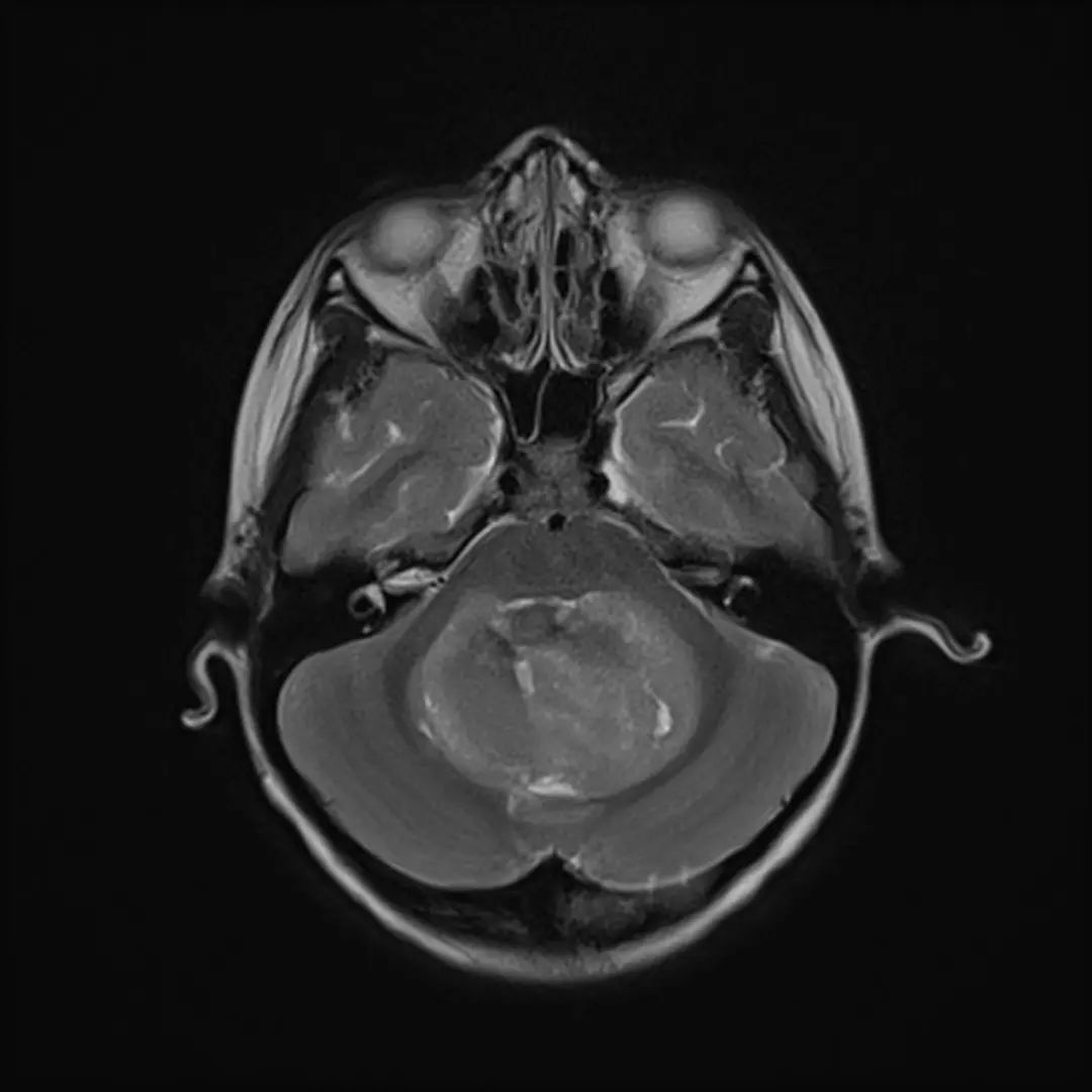 经典型髓母细胞瘤,影像诊断图片解析