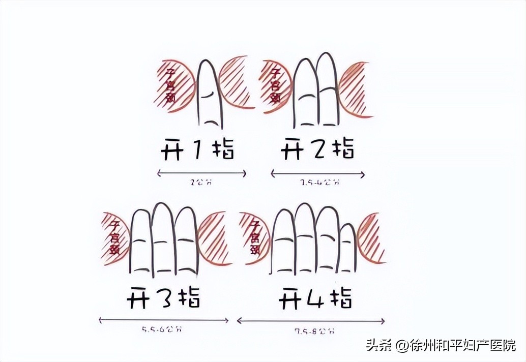生孩子开十指的手术,生孩子开十指要使劲吗