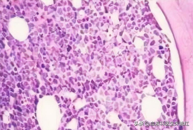 MDS白细胞低怎么治疗？有哪些注意事项？