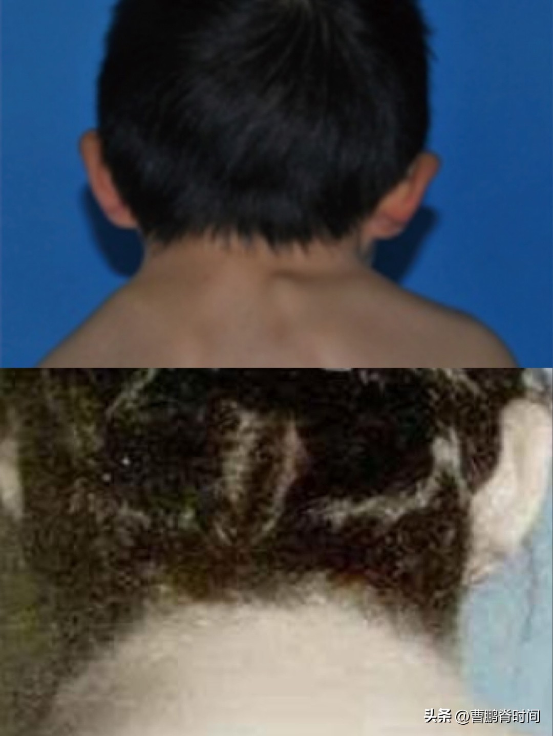 脖子两侧筋痛要警惕三种疾病,天生短脖子怎么改善