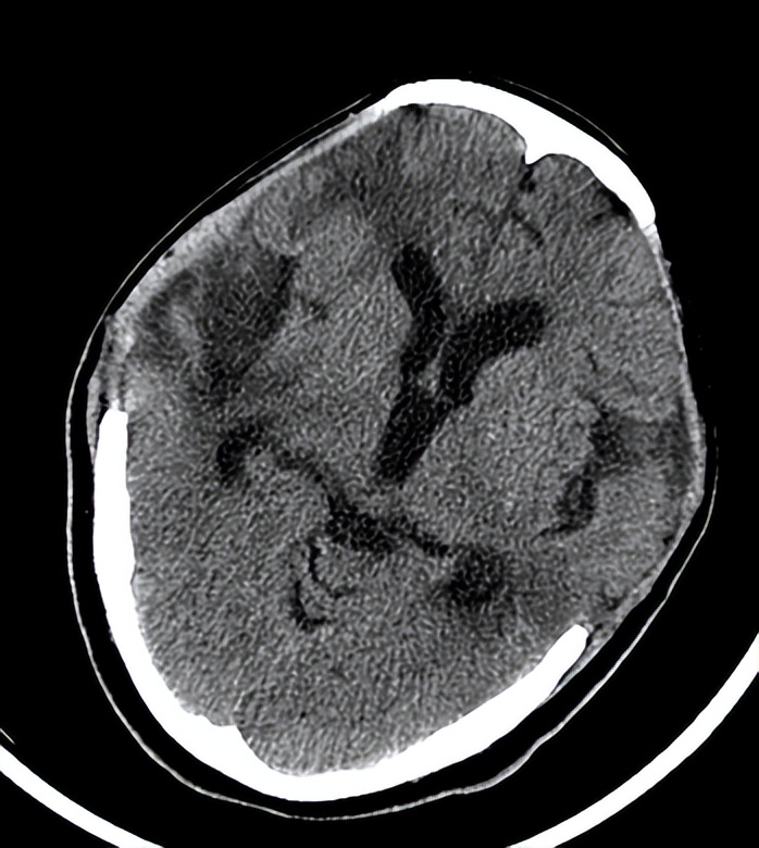 医院成功救治重型颅脑患者,特重型颅脑损伤治愈案