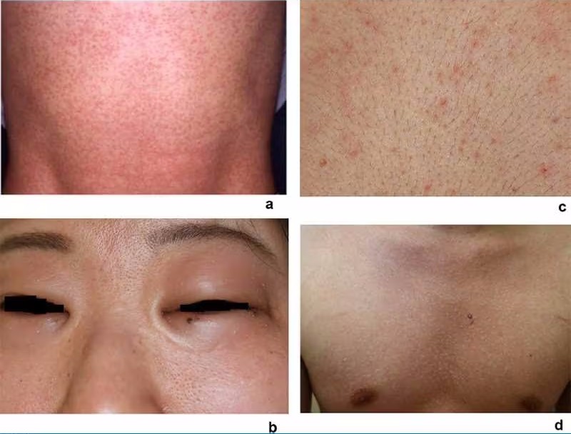 胆碱性荨麻疹查得出来吗,胆碱性荨麻疹需要查什么