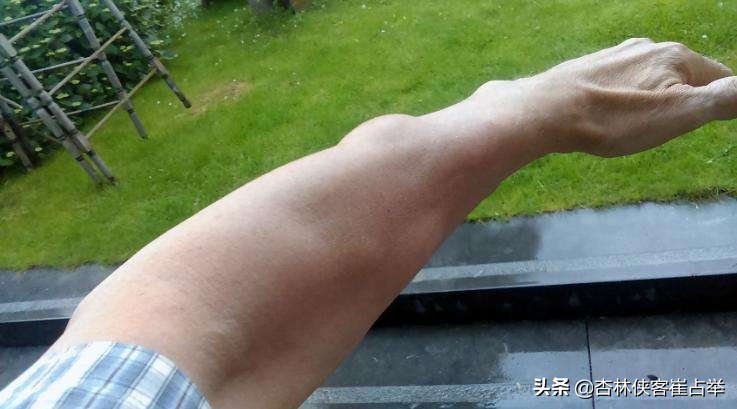 结节息肉囊肿最佳食疗方,结节息肉脂肪瘤用什么中药