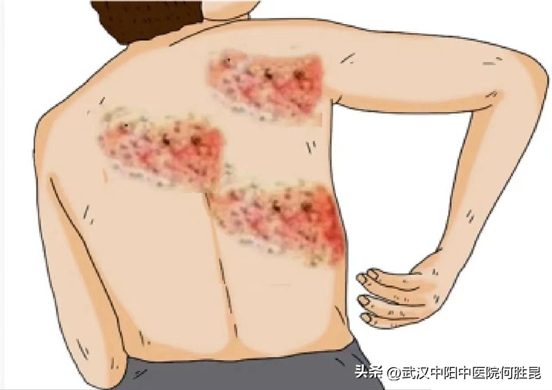带状疱疹后遗症神经痛的针灸处方,带状疱疹神经痛后遗症中医处方