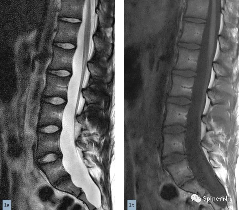 硬膜囊扩张是什么意思,硬膜囊扩张压迫神经