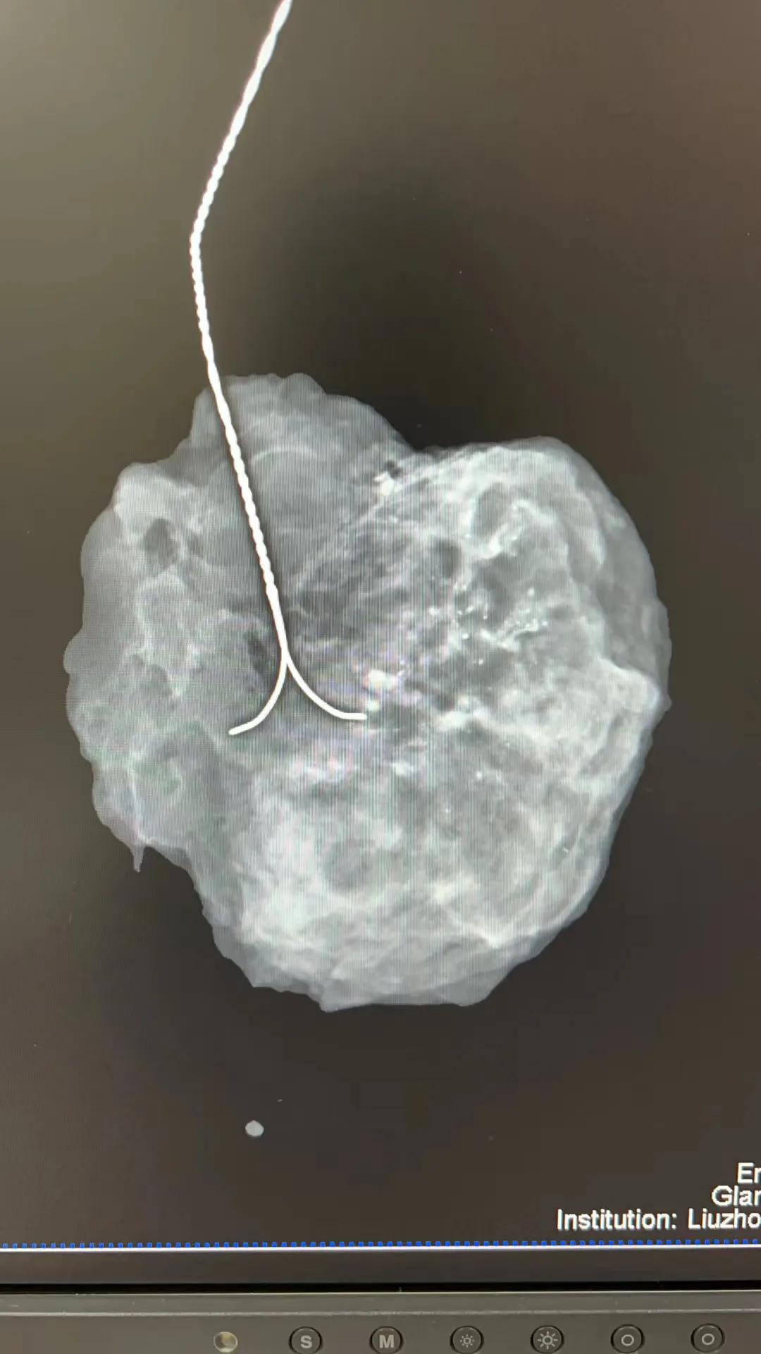 乳腺钙化需要做手术吗是什么意思,乳腺钙化什么意思