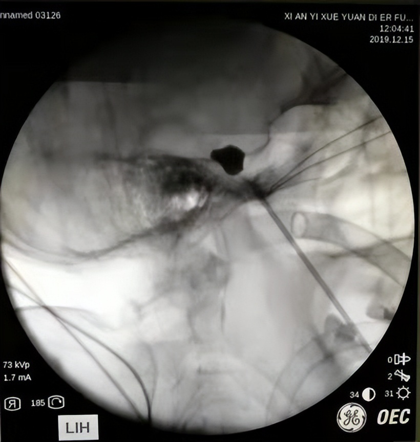 三叉神经引起的牙痛怎么快速止痛,三叉神经痛吃什么祛风止痛的药