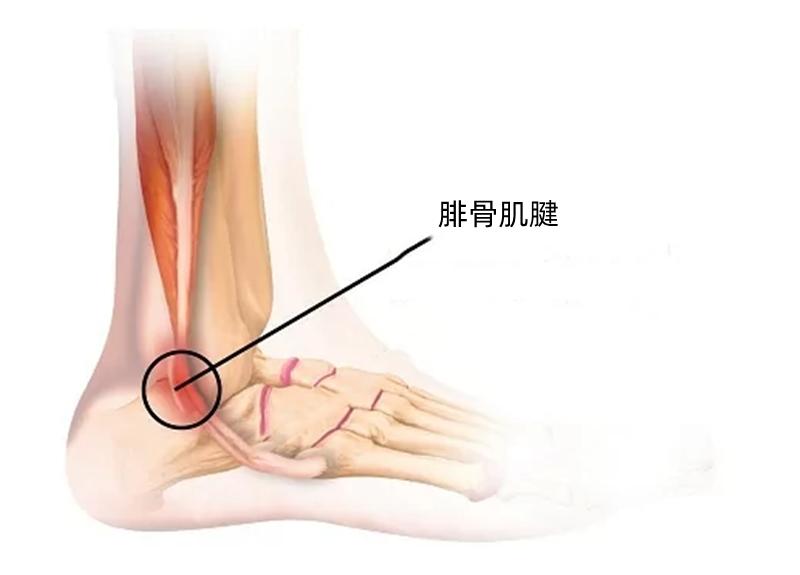 走路脚踝发出清脆响声突然很疼,走路脚踝发出清脆响声