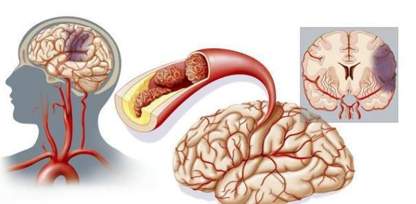 常见的诱发癫痫的病因有什么,哪些病会引起癫痫
