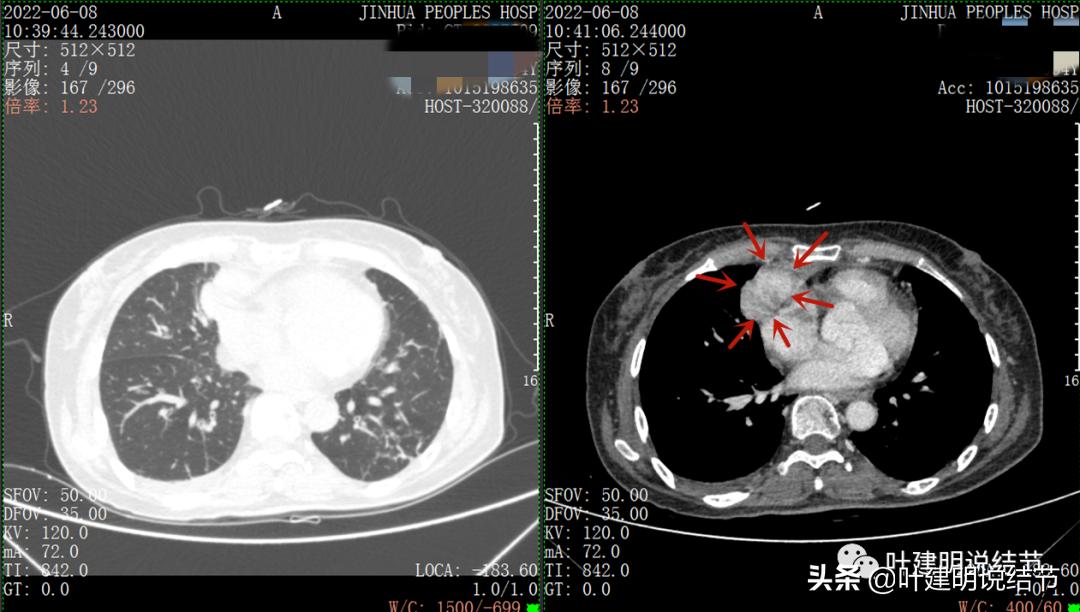 这位老乡，乏力来查，查出这么大个的纵隔肿瘤！会是什么呢？