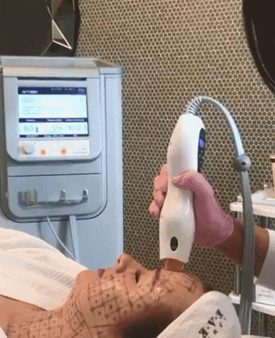 热玛吉处理脖子松弛效果怎么样,颈部皱纹很深热玛吉能去除吗