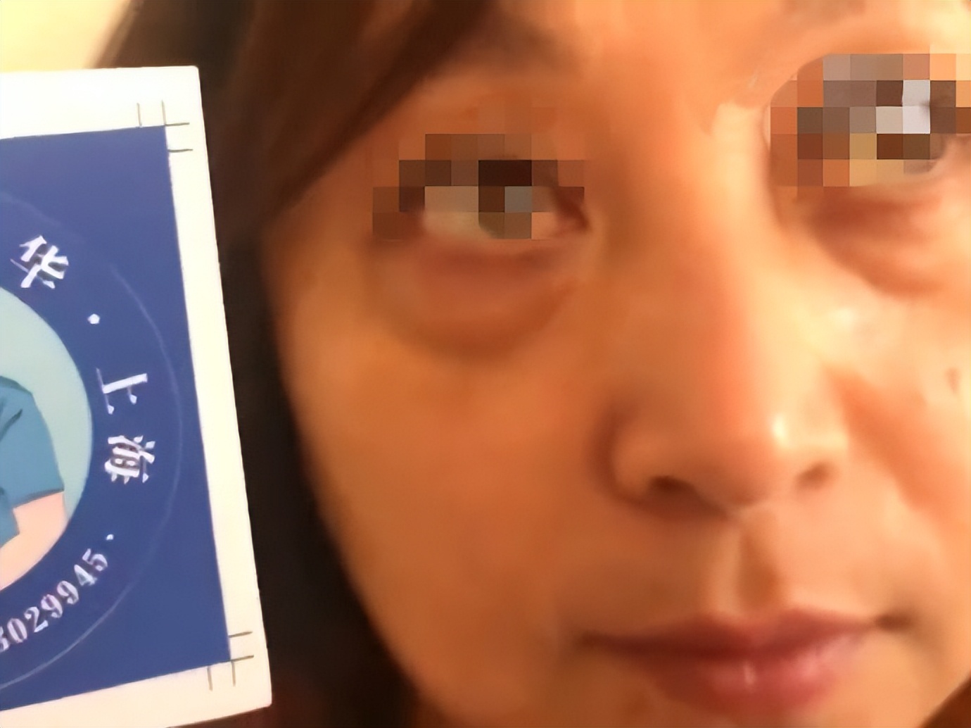 外切祛眼袋1-7天恢复图真人,外切祛眼袋恢复过程