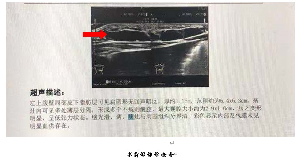 淋巴管瘤的微创治疗,淋巴管瘤微创介入手术第二天