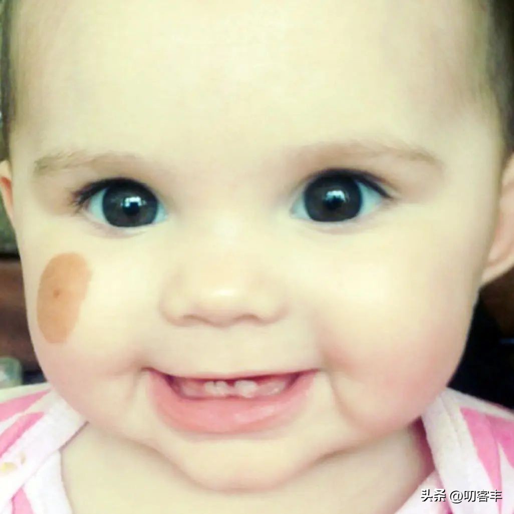 婴儿的咖啡牛奶斑怎么治疗,宝宝的咖啡牛奶斑图片