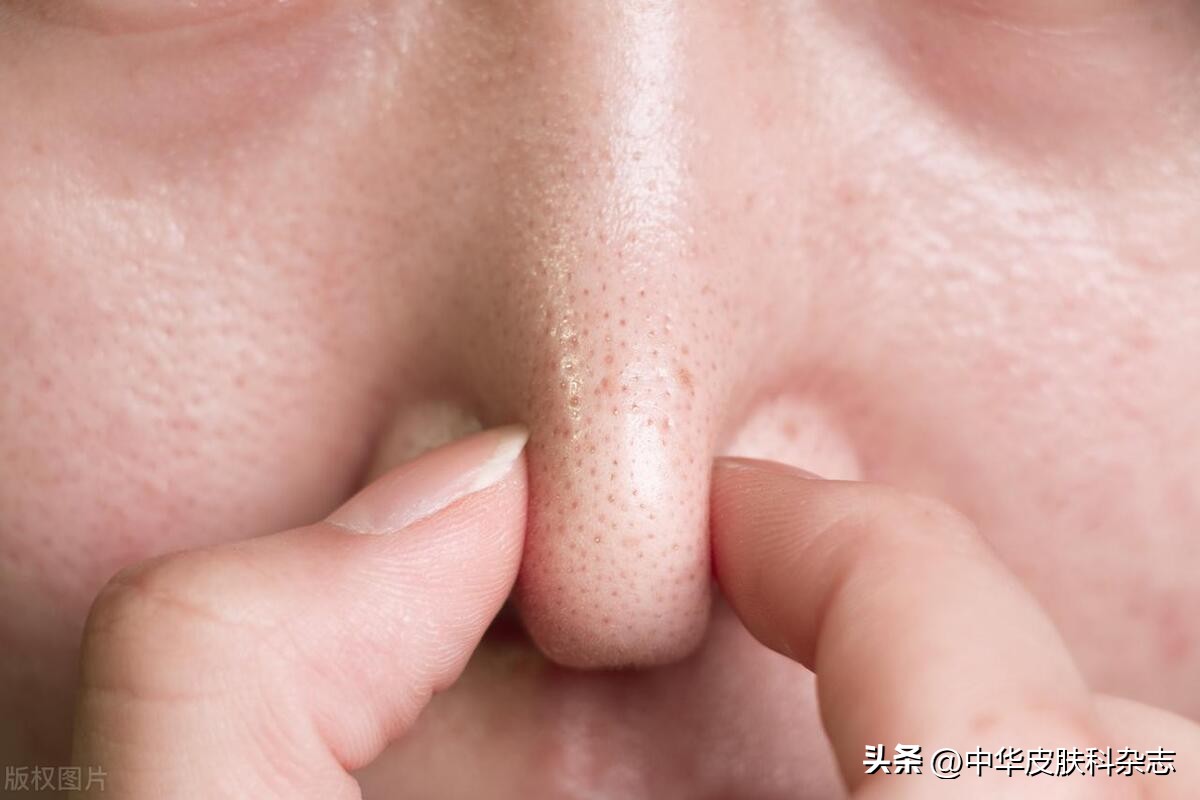 鼻翼红斑有鳞屑,鼻翼有斑是怎么回事