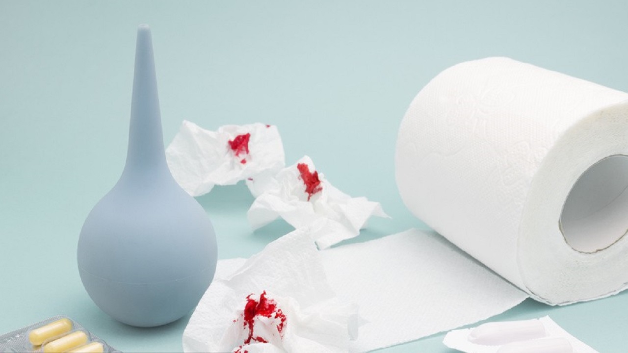 26岁女孩多次肛裂,女性哪些生活习惯会引发肛裂