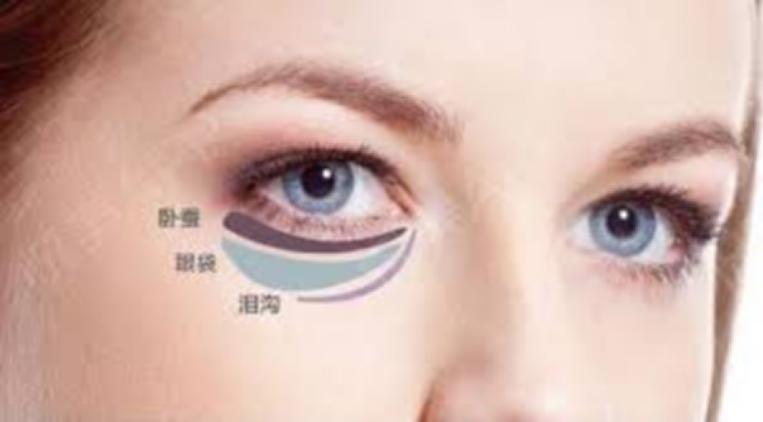 眼袋和卧蚕有什么区别怎么祛眼袋,眼袋可以改善成卧蚕吗