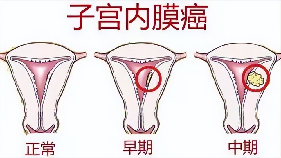 58岁女子小腹疼痛，按盆腔炎治疗半年无效，换家医院才发现误诊了