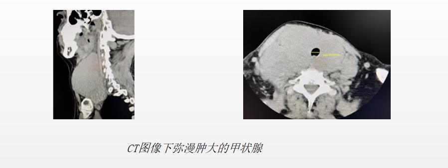 64岁女患者脖子肿痛，病因为何？多学科诊疗让患者获益最大化
