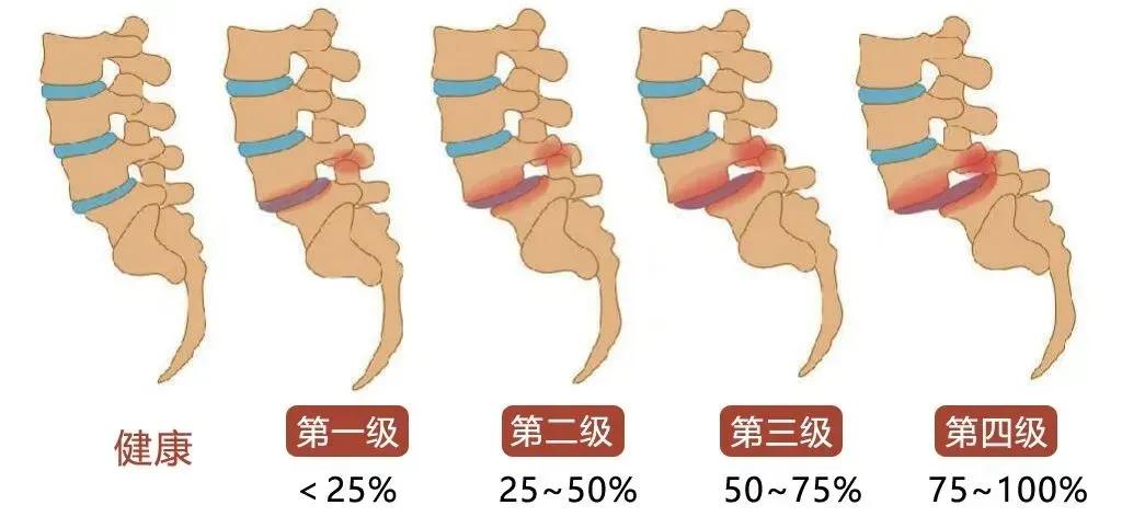 腰椎4节滑脱怎样治疗,中医怎样治疗腰椎滑脱