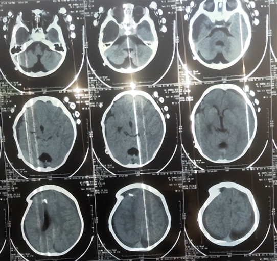 蛛网膜囊肿合并脑积水腹腔分流术,治疗蛛网膜囊肿引起脑积水严重吗