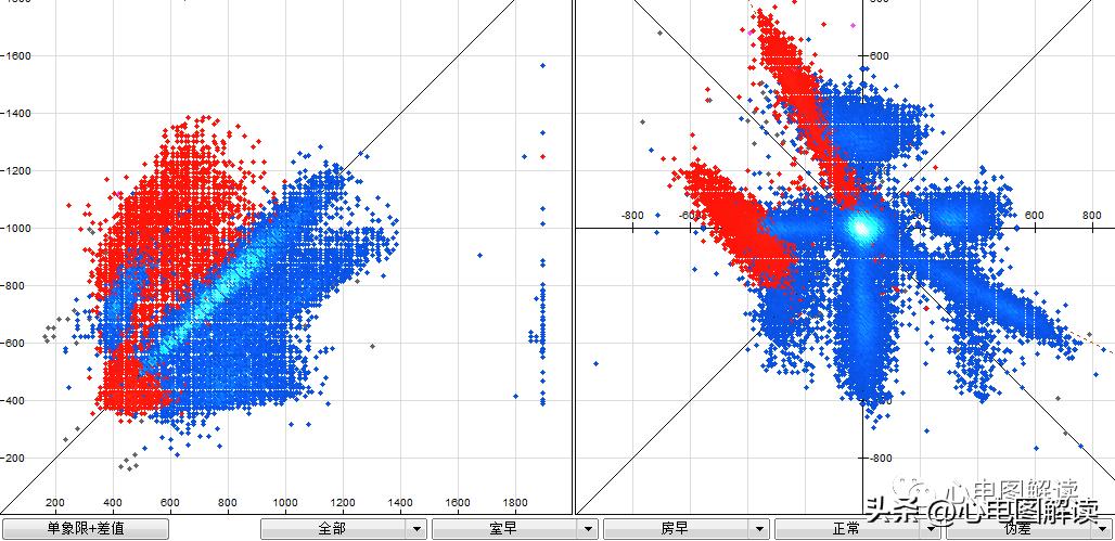 窦性心律偶见室性融合波,室性并行性心律