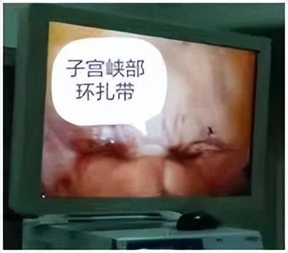 腹腔镜下的宫颈峡部环扎术，助宫颈机能不全女性圆母亲梦