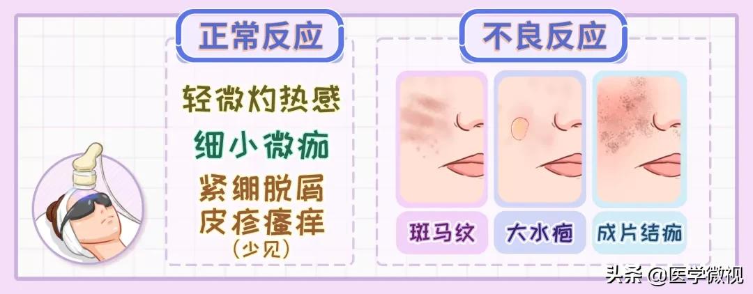 光子嫩肤结痂后皮肤脱皮泛白,光子嫩肤后脱皮