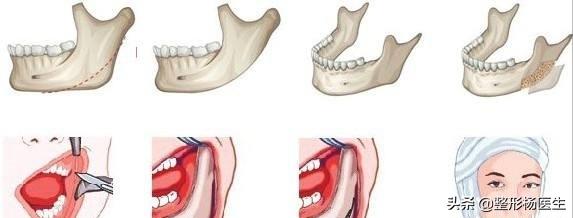 削骨后遗症最严重的后果,削骨失败案例后遗症