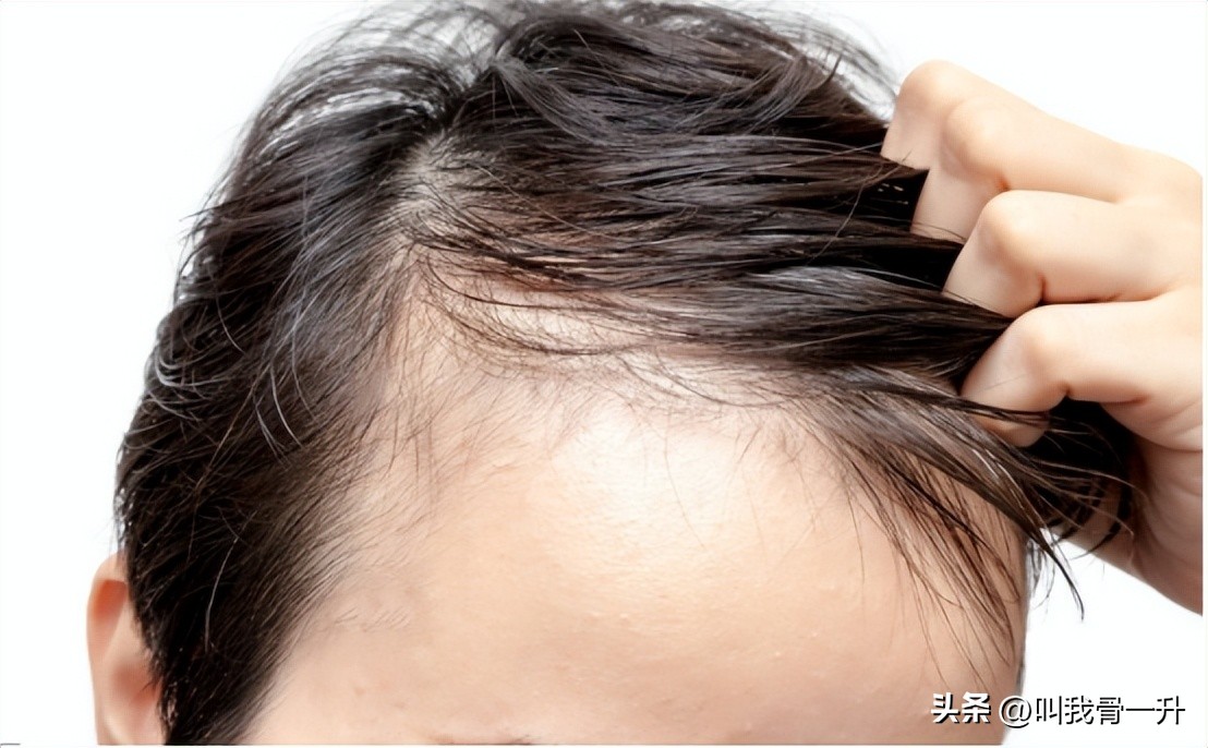 12岁小孩头发稀少怎么变浓密,怎么让头发变浓密食疗