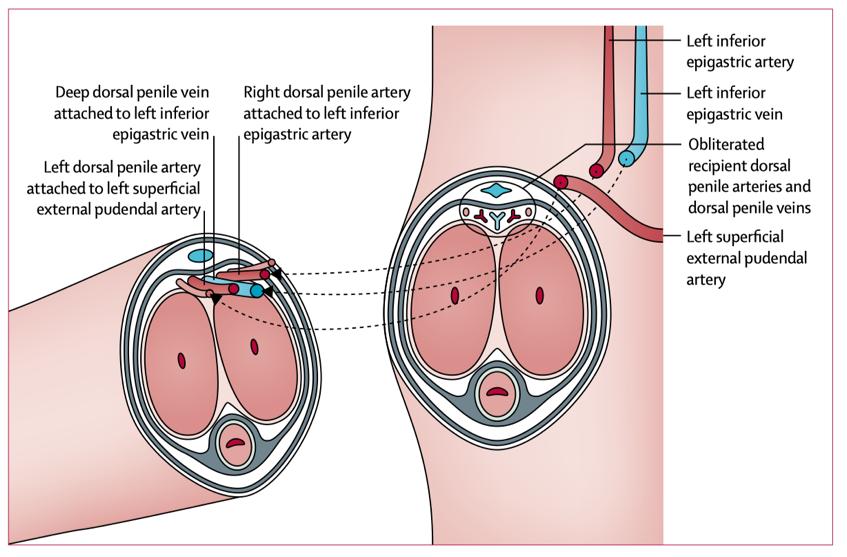 【丁丁历险记·毛大夫版】“断枪重铸”——阴茎离断再植的那些事