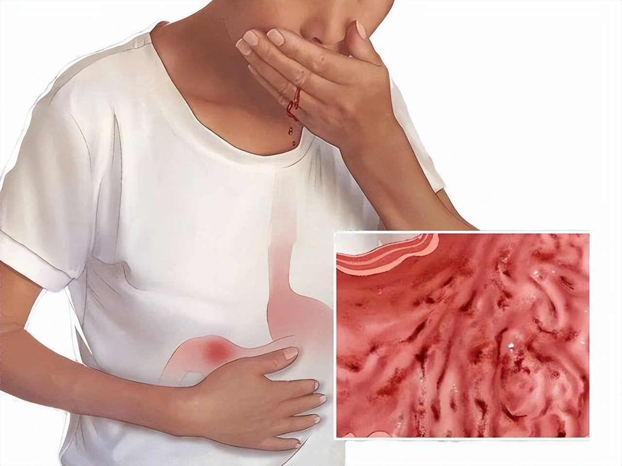 非萎缩性胃炎伴糜烂吃奥美拉唑吗,非萎缩性胃炎伴糜烂能吃奥美拉唑