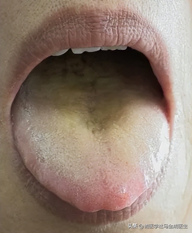 上半身头部出汗多吃知柏地黄丸,阴虚盗汗吃知柏地黄丸