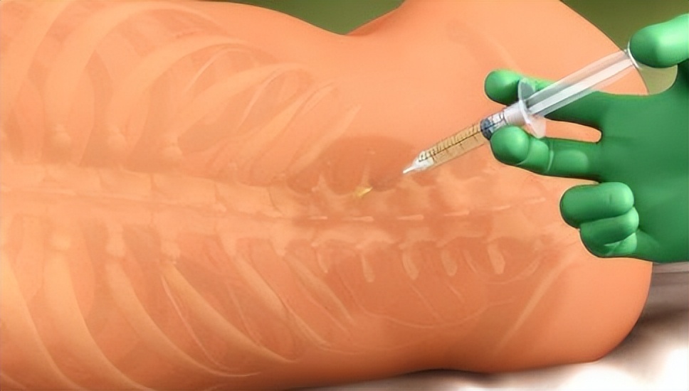 全身麻醉有死亡的风险吗,全麻手术为什么要全身麻醉