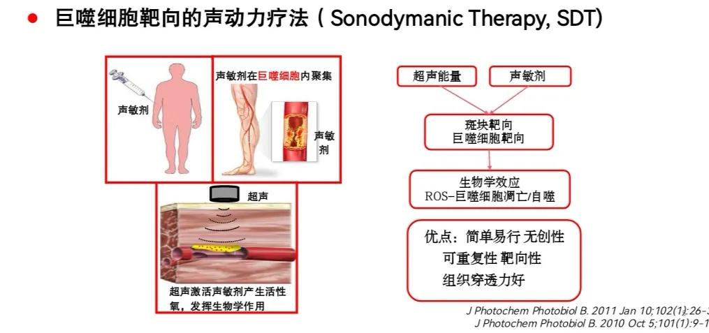 黑龙江治疗动脉粥样硬化的专家,声动力治疗实验