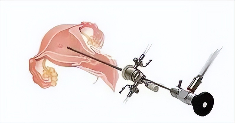 【全国肿瘤防治宣传周】关注异常阴道出血防治妇科肿瘤