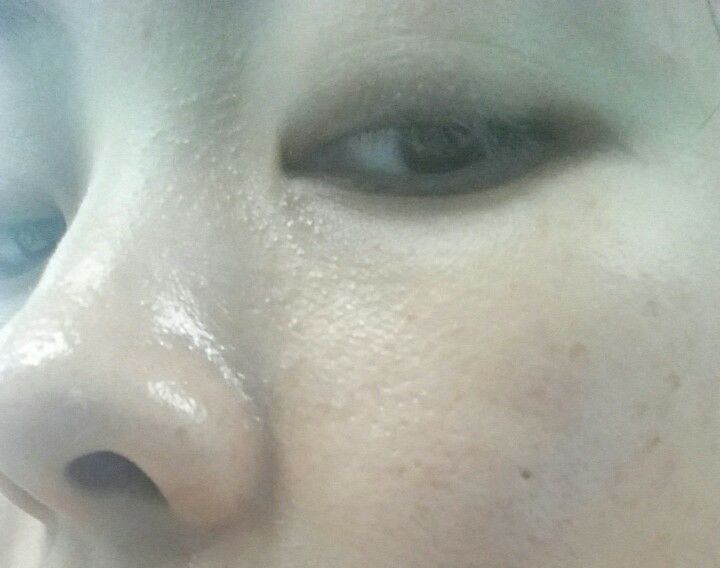 额头眉心发红有闭口粉刺,眉心鼻头频繁起粉刺怎么办