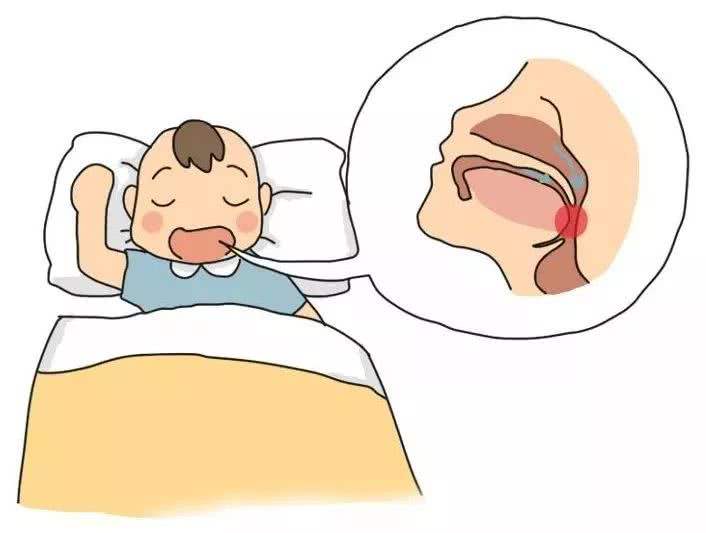 小儿打鼾为什么？该怎么办？