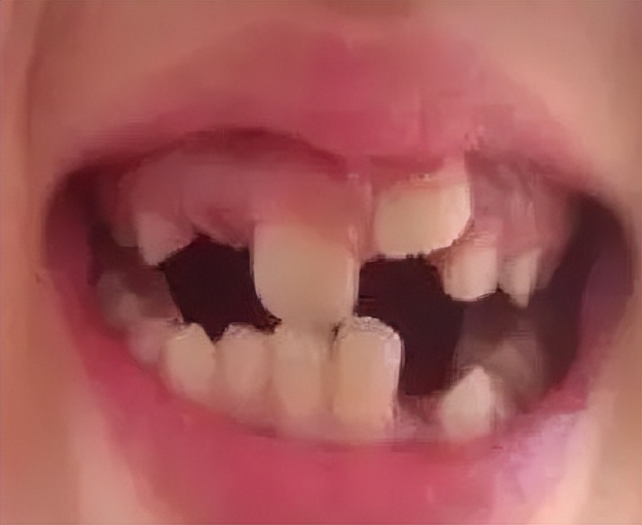 儿童缺牙可以镶牙吗,老年人缺牙后如何镶牙