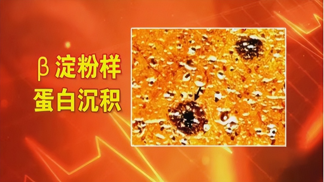 由于睡眠不足造成的危害真实案例,影响睡眠的5大疾病要警惕