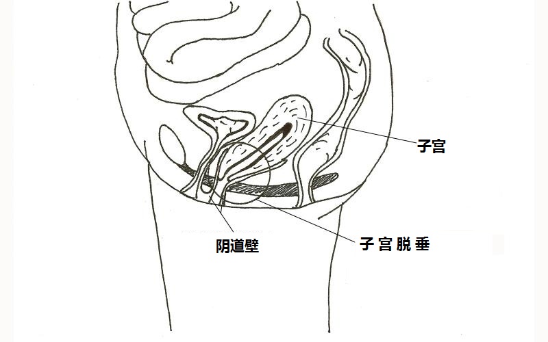 73岁奶奶宫颈脱垂,80多岁子宫重度脱垂